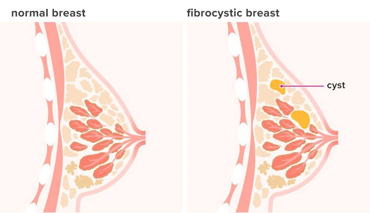 fibrocystic breasts are alarming signs of too much estrogen in your body