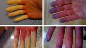 Rashes on palms caused by Hepatitis C Virus