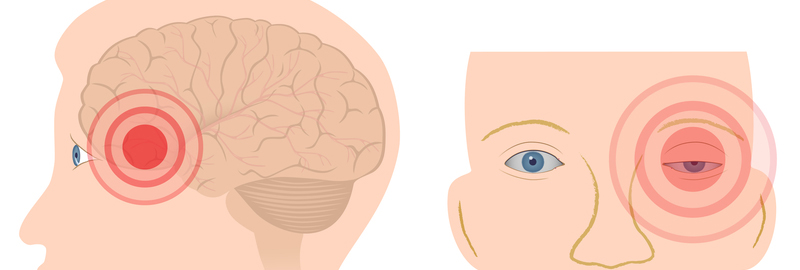 Cluster headaches