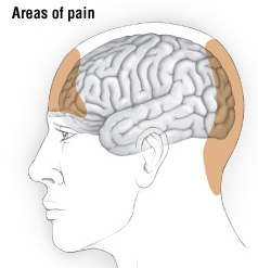 tension headaches